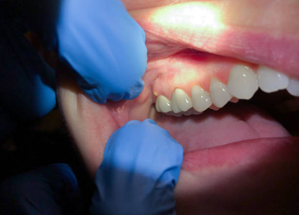 Best Emergency Tooth Extraction in Fruitdale, CA