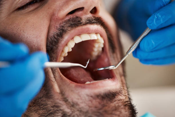 Best Emergency Wisdom Teeth Removal in Fruitdale, CA